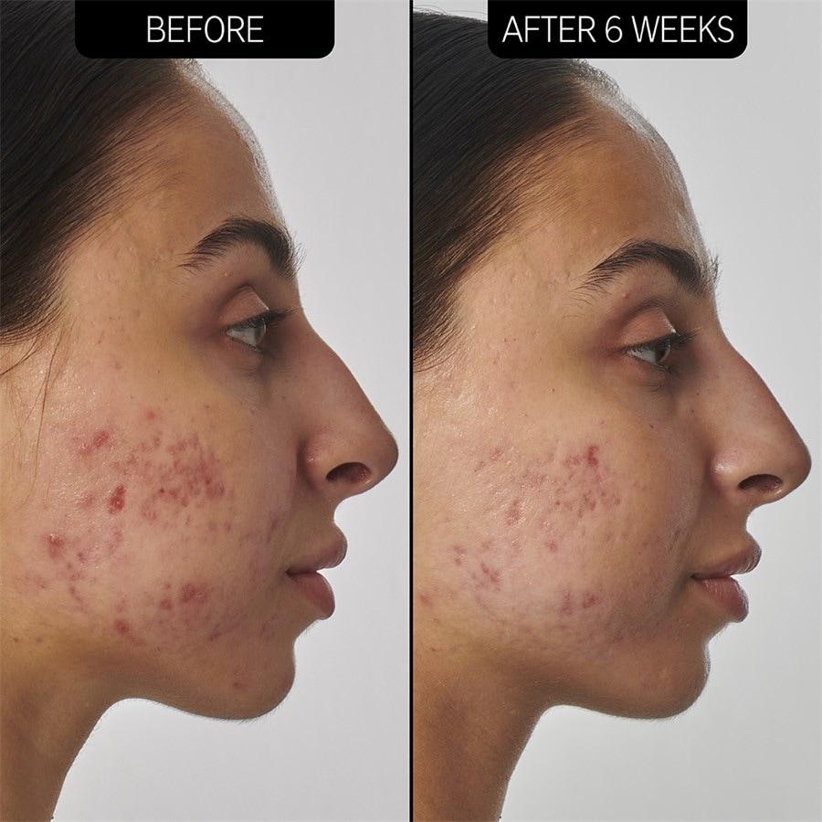 The INKEY List Sieri SuperSolutions 1% Retinol Serum Prezzo Ridotto