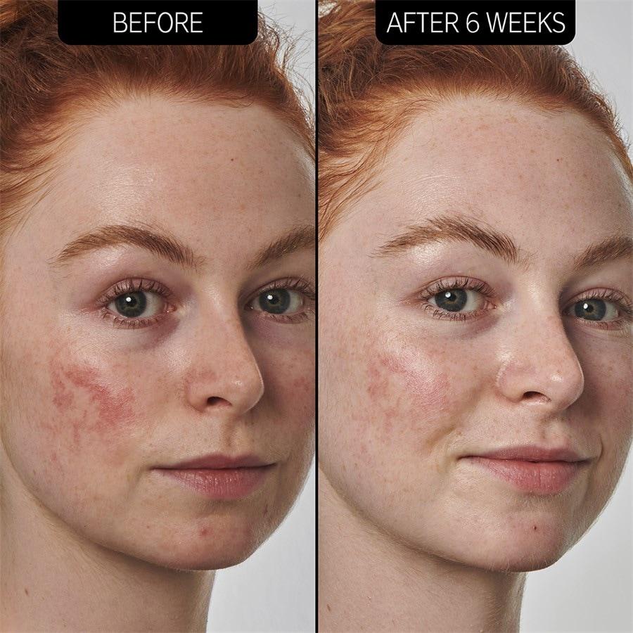 The INKEY List Sieri SuperSolutions 10% Azelaic Acid Serum Fino al 65% di sconto