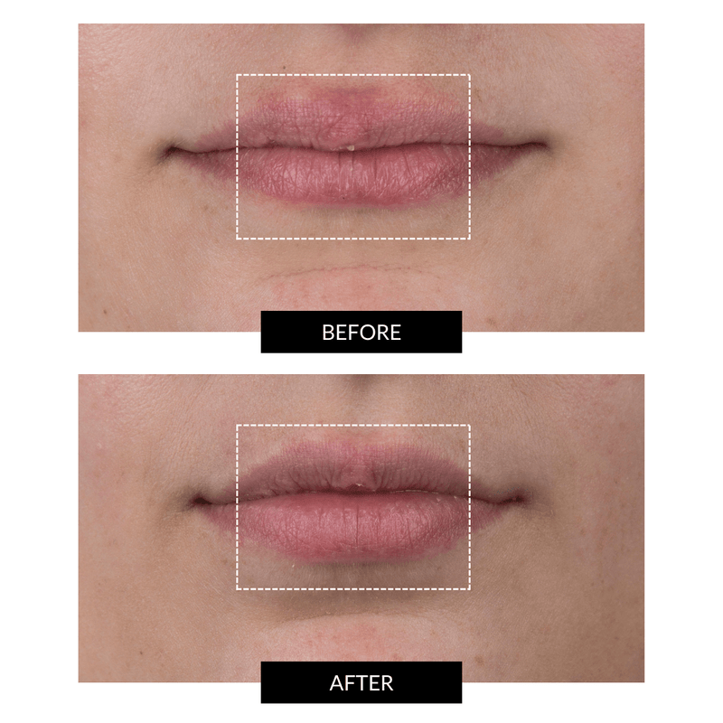 CurrentBody Skin LED Lip Perfector Convenienza