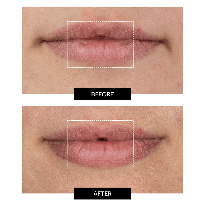 CurrentBody Skin LED Lip Perfector Convenienza