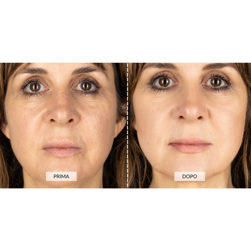 CurrentBody Skin Dispositivo a radiofrequenza per il viso RF Currentbody Skin Presa