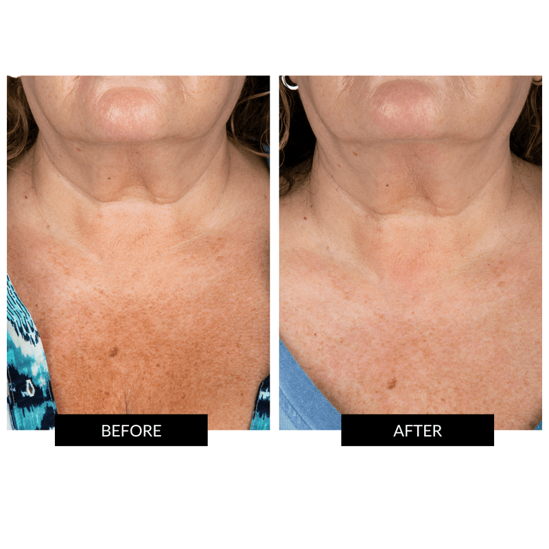 CurrentBody Skin Maschera Collo e Décolleté Hotsell