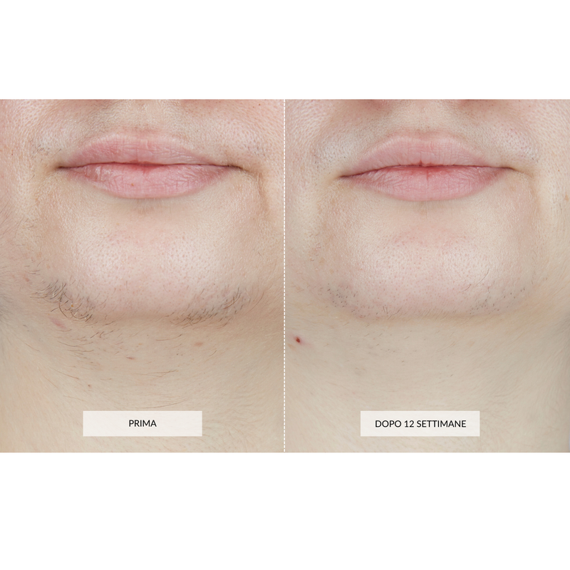 CurrentBody Skin Dispositivo di Epilazione Laser I Più Venduti