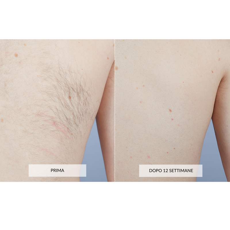CurrentBody Skin Dispositivo di Epilazione Laser I Più Venduti