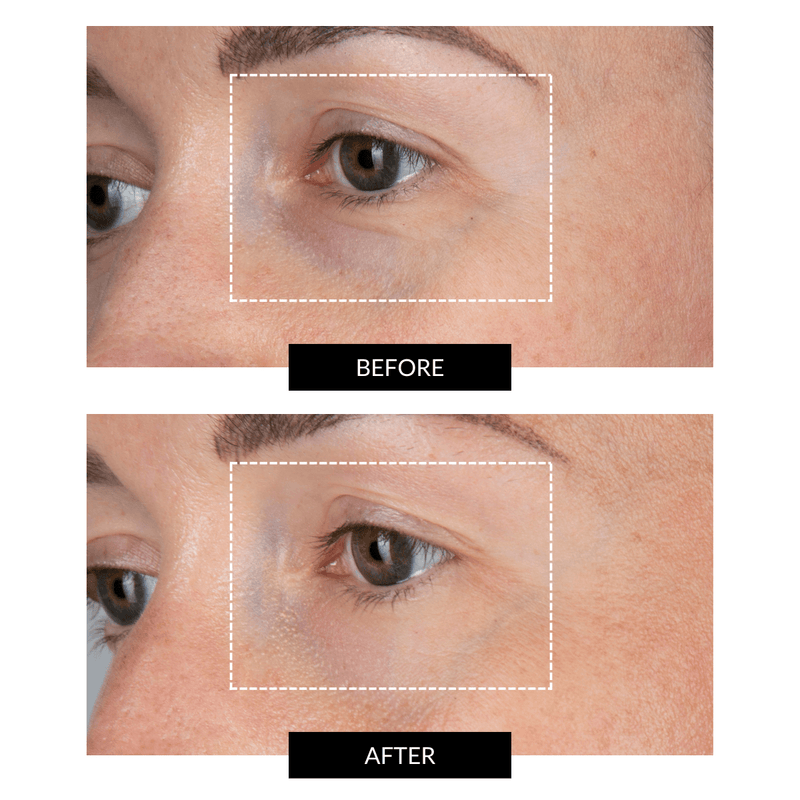 CurrentBody Skin LED Eye Perfector & 5 Eye Hydrogel Masks (del valore di 249€) Promozione