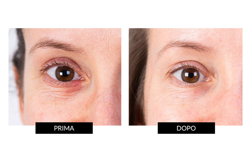 Nira Skin Nira Precision Laser Saldi