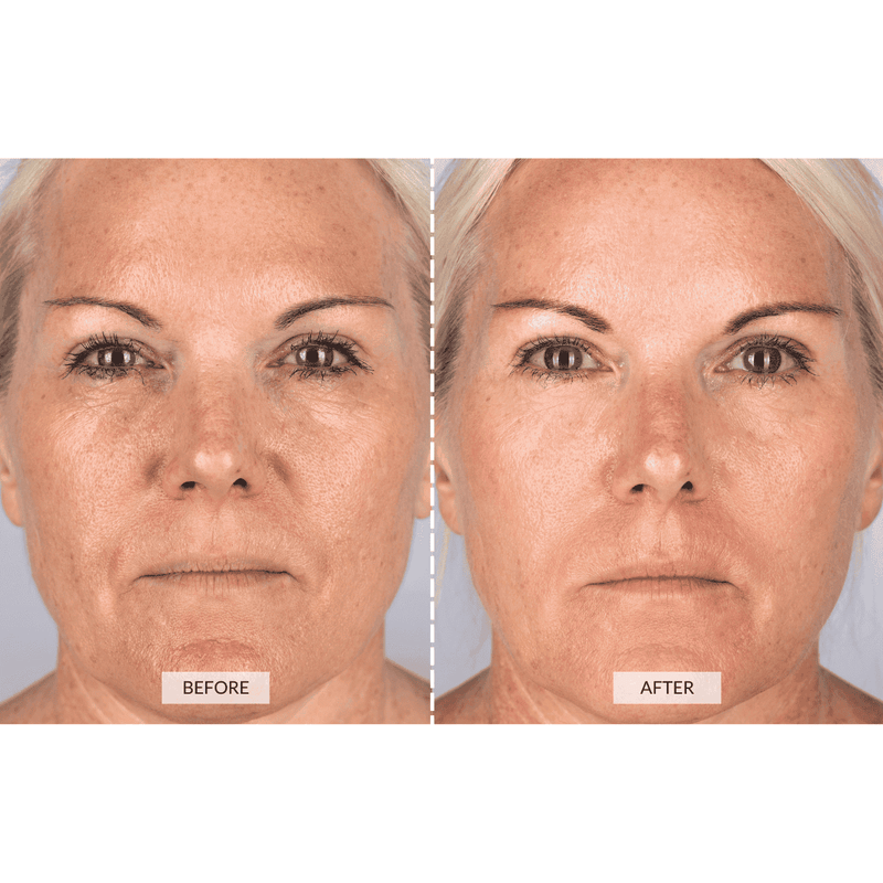 CurrentBody Skin Dispositivo a radiofrequenza RF x Sonia Sélaire Presa