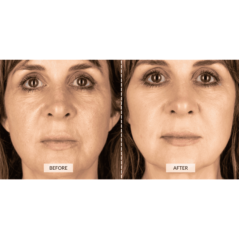 CurrentBody Skin Dispositivo a radiofrequenza RF x Sonia Sélaire Presa