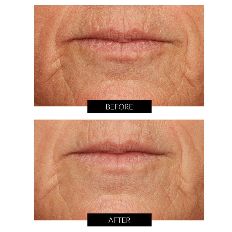 Lancer Acid Peel al Limone Caviale con Acido Glicolico (50ml) Affare Del Giorno